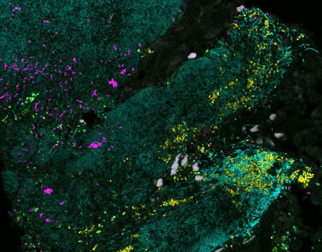 Bacteria forming a mixed biofilm on colon cancer tissue. Credit: Jessica Mark Welch, Blair Rossetti and Christine Dejea