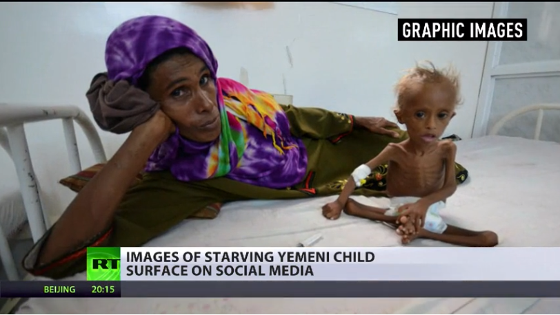 Svält under kriget i Jemen - Foto: RT.com
