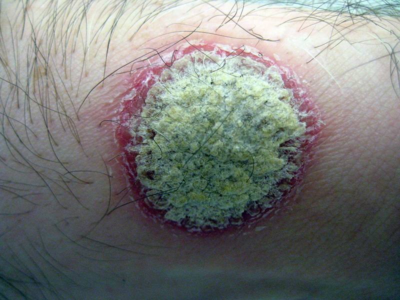 Plack-Psoriasis - Foto: James Heilman (MD), Wikimedia