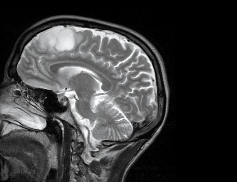 Hjärntumör - Foto: Stuart-Farrimond