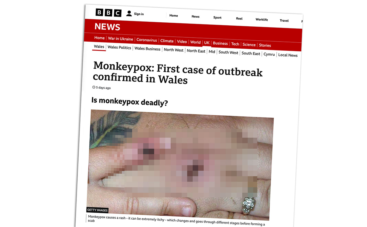 Monkeypox i BBC. Montage: NewsVoice. Getty-bilden är pixelerad för att skydda upphovstätten
