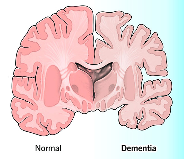 Alzheimers sjukdom, dementia
